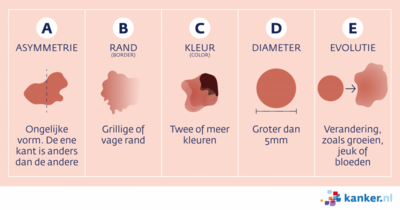 ABCDE-regel melanoom