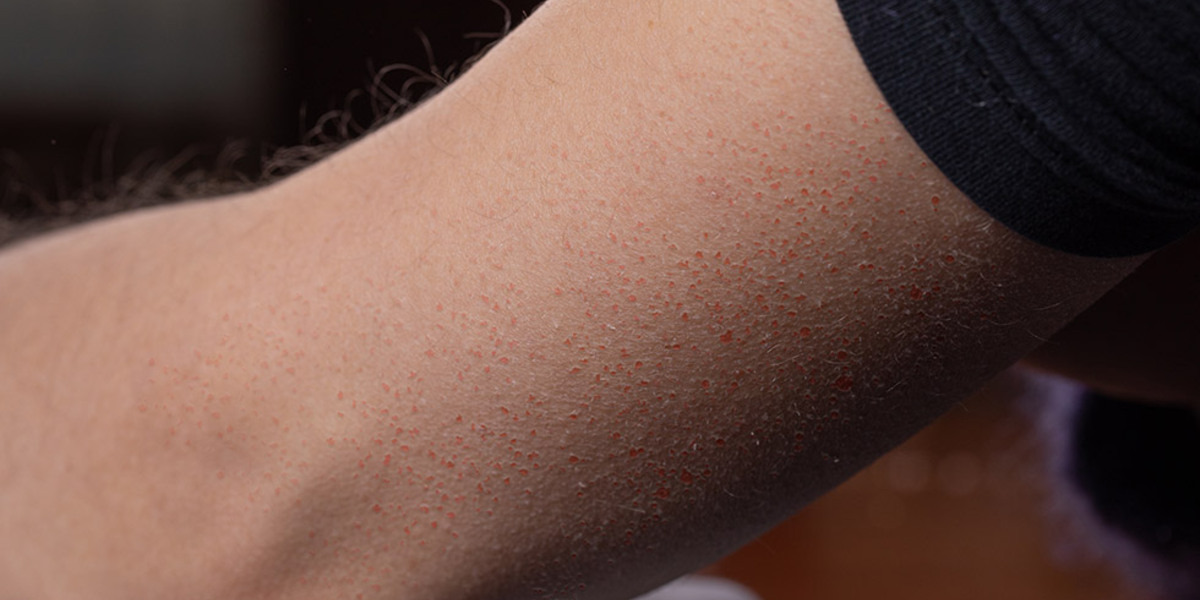 keratosis pilaris