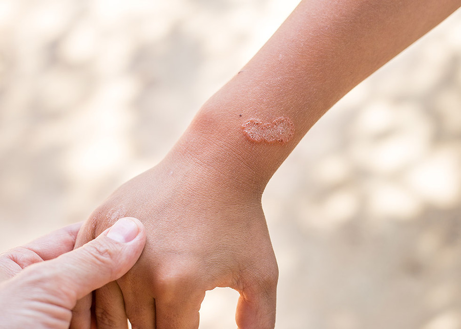 Wat te doen tegen schurft? Pazzox,