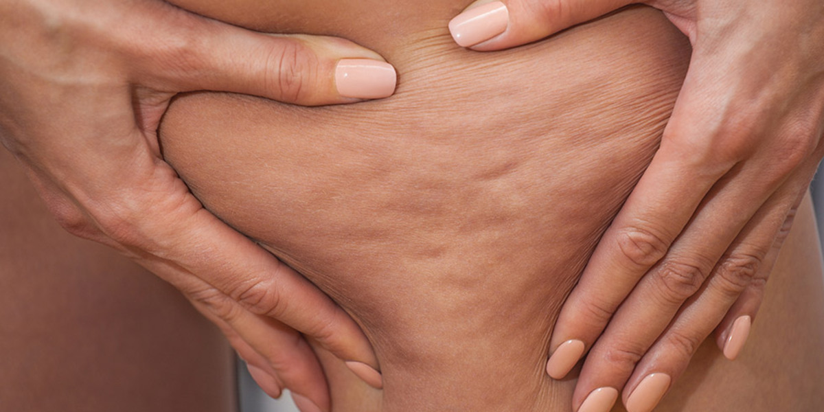 Cellulite