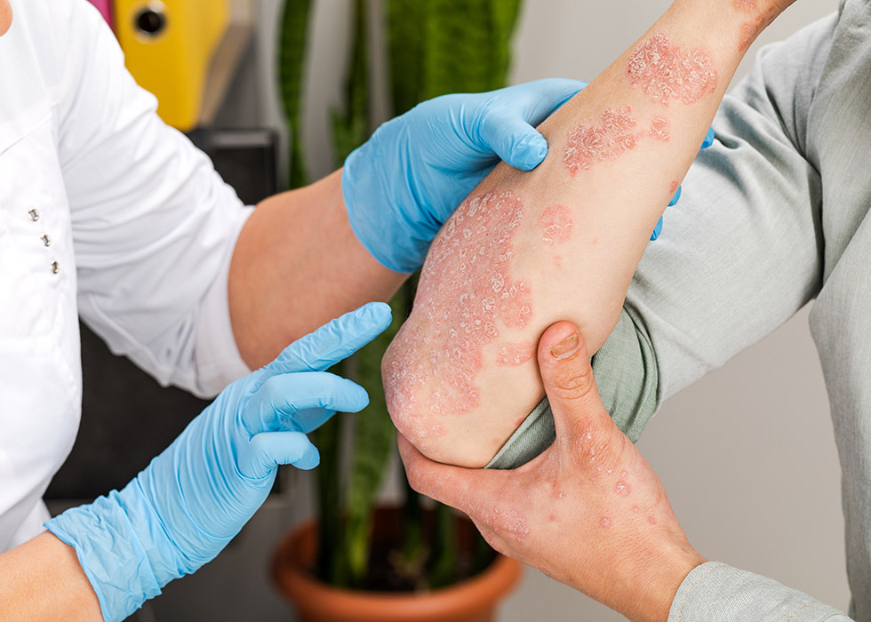 Psoriasis op arm laten bekijken door arts