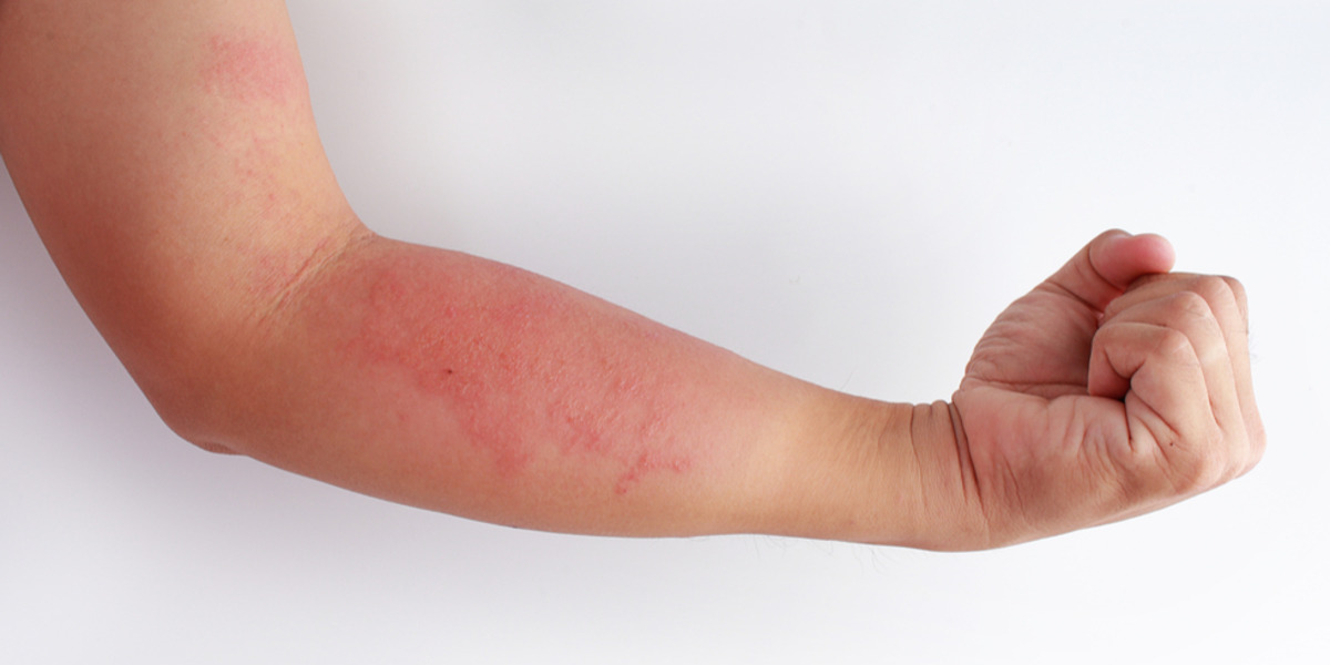 Peau extrêmement sèche ou eczéma?
