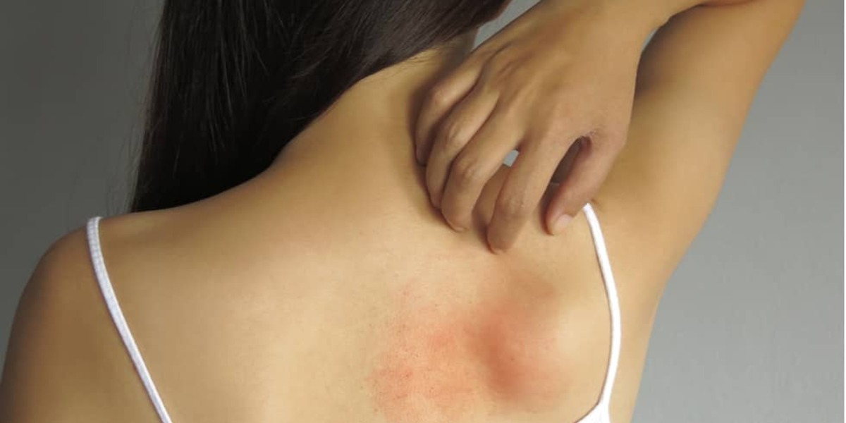Schimmelinfectie op de huid