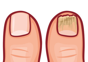 Ongles calcaires : quelle est la cause et comment remédier à ce problème?