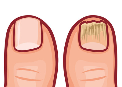 Gezonde nagel versus kalknagel