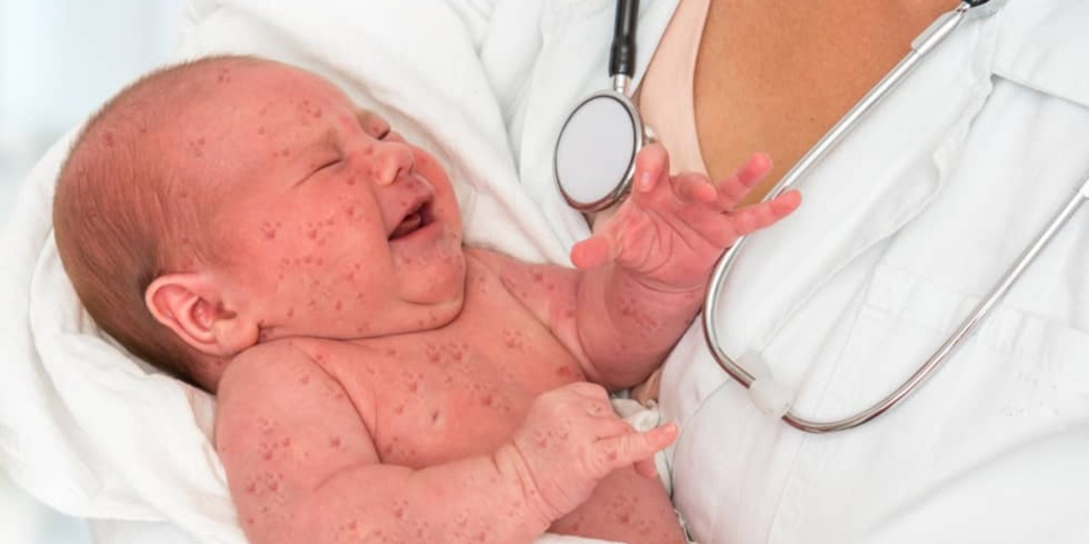Baby met koortsblaasjes