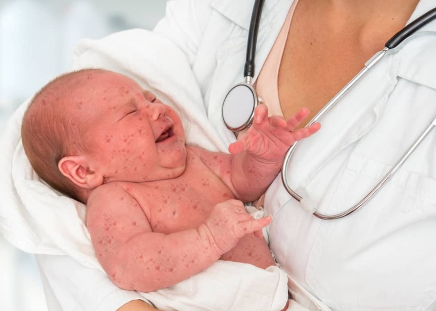 Parameters priester taart Een koortslip, gevaarlijk voor je baby? - Pazzox, online apotheek