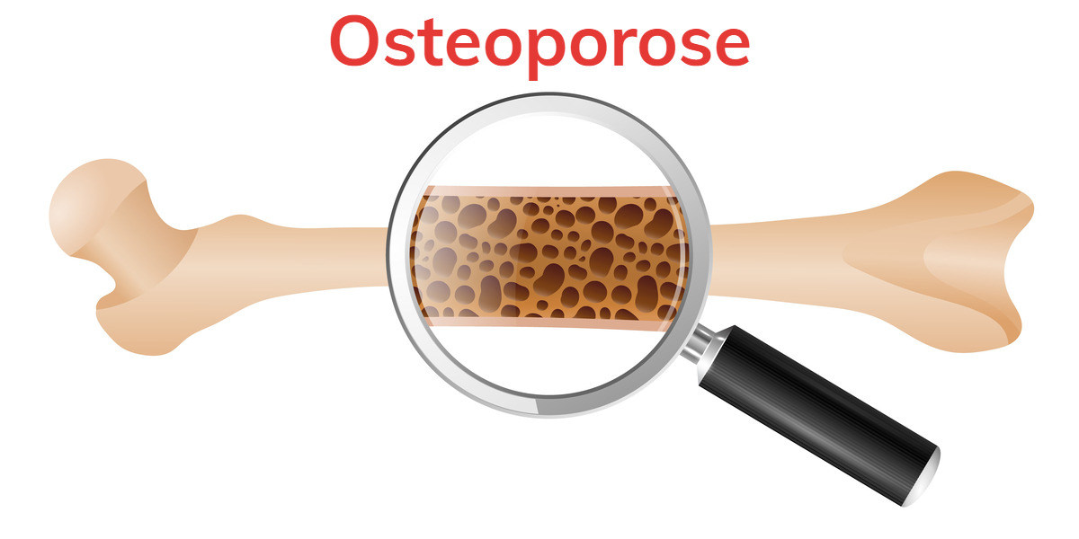 Os poreux dans l'ostéoporose