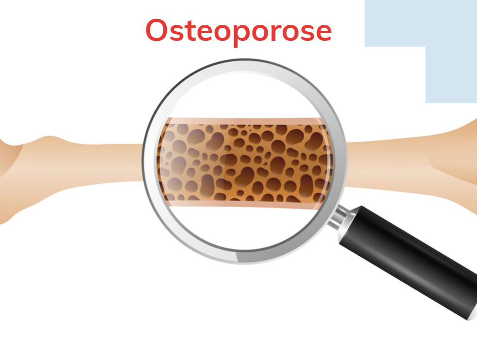 Os poreux dans l'ostéoporose