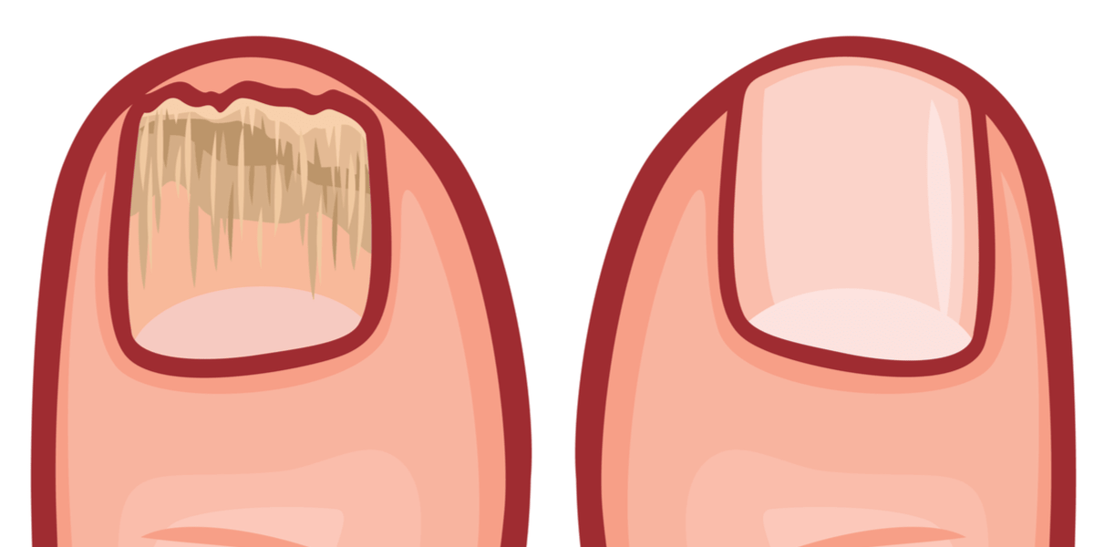 à gauche vous voyez un ongle de champignon, à droite un ongle d'orteil sain