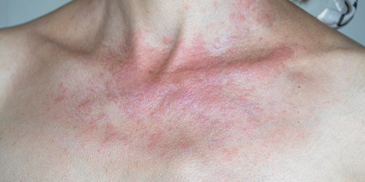 De beste tips om zonneallergie te behandelen
